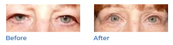 Blepharoplasty, or upper eyelid surgery, image 01