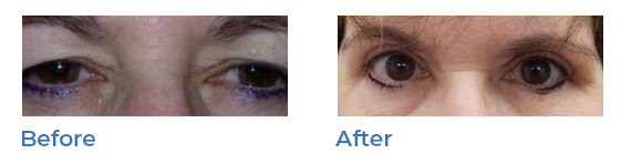 Blepharoplasty, or upper eyelid surgery, image 02